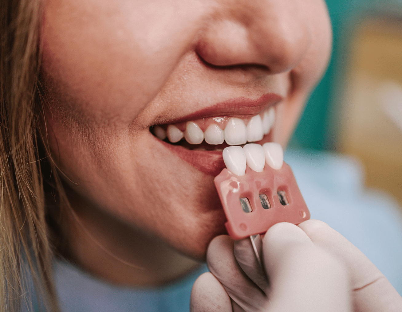 Patient getting dental veneers matched