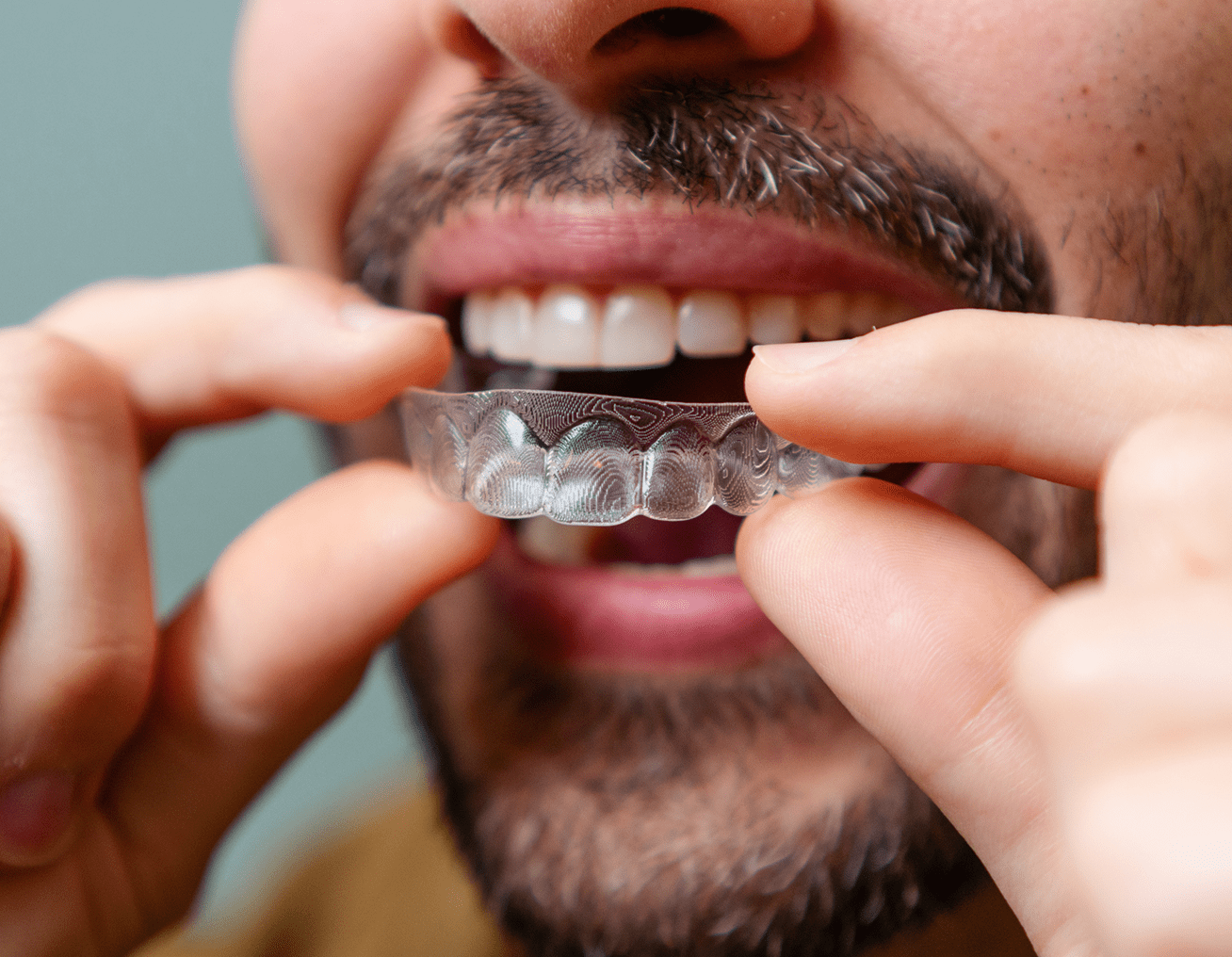 Person inserting a teeth straightener