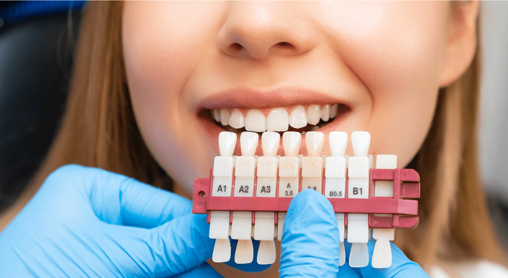 Dental shade matching with teeth samples