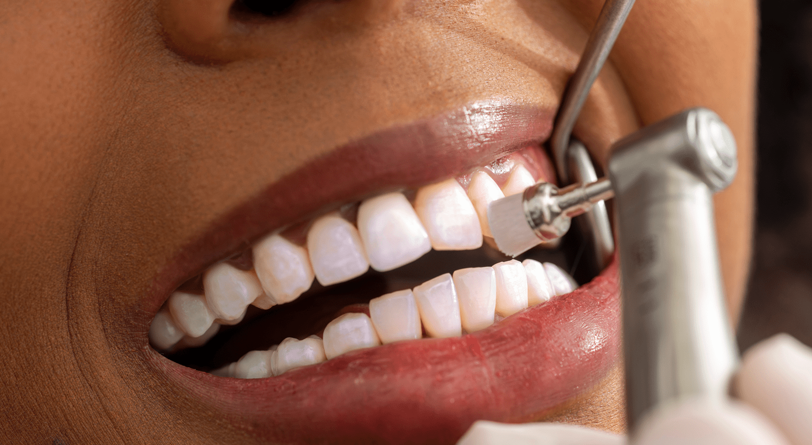 Teeth being polished by dentist